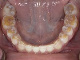 6 Facts About The Connection Between Celiac Disease and Dental Enamel Defects