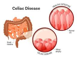 5 Reasons Why the Answer to “Is a Little Gluten Ok for Celiac?” is No