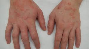 6 Essential Facts About Dermatitis Herpetiformis Children and Celiac Disease