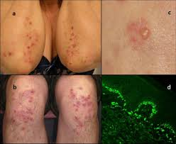 6 Essential Steps for Dermatitis Herpetiformis Diagnosis and Management