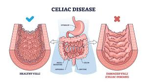 7 Dangerous Truths About Silent Celiac Disease Damage Without Stomach Pain