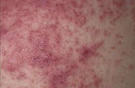 7 Vital Facts About Celiac Disease Rash Pictures and Treatment
